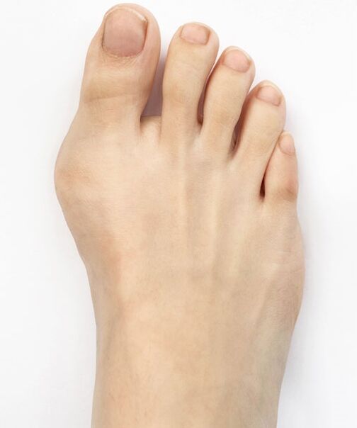 Hallux valgus vor der Anwendung des Hondro Sol Valgus-Sprays