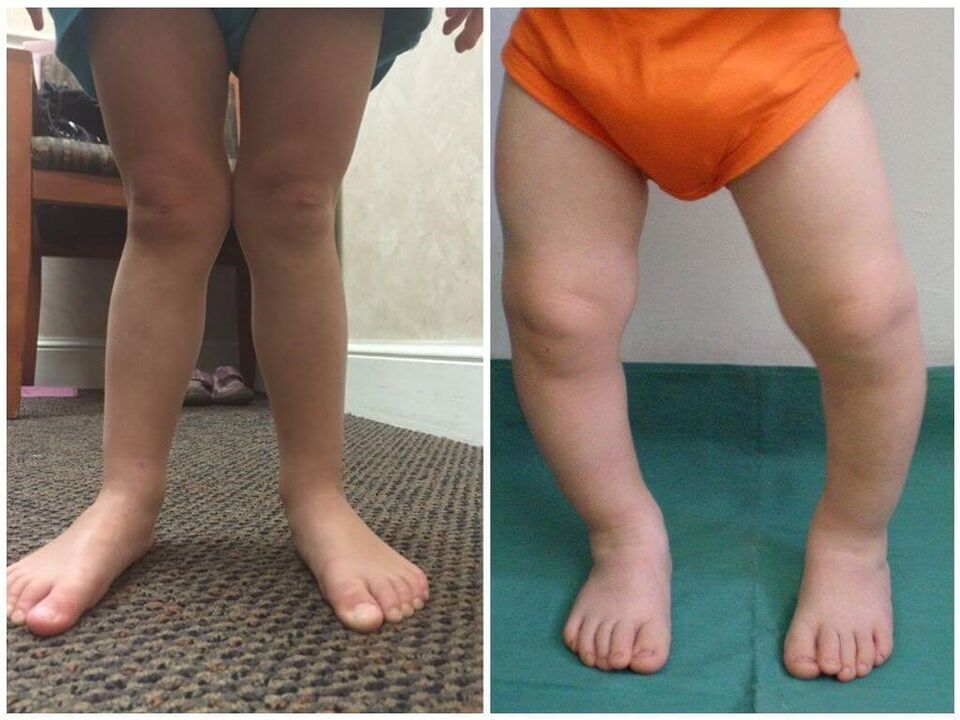 Valgus -Deformation bei Kindern verursacht