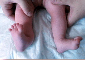Valgus -Verformung bei den Symptomen der Kinder