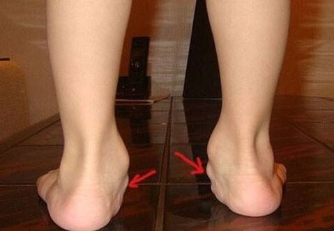 Valgus -Verformung der Füße bei Kindern