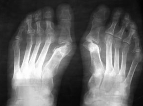 Indikationen für Operationen unter dem Valgus des Fußes