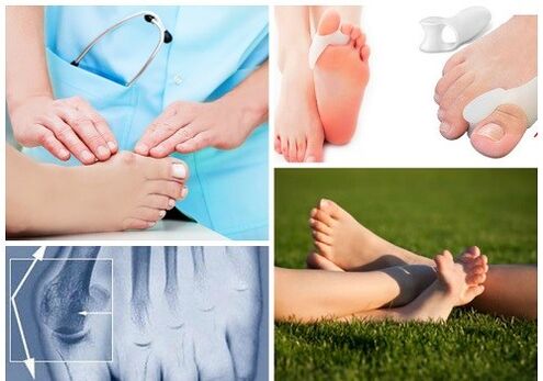 Behandlung der Valgus -Deformation