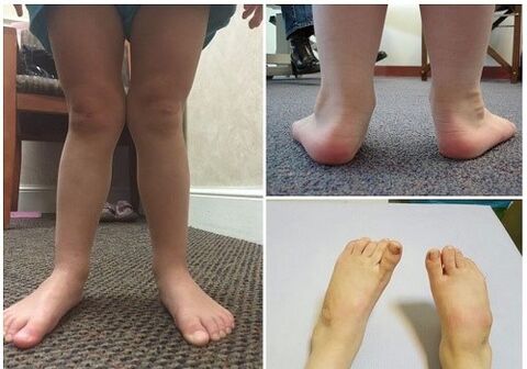 Valgus -Verformung bei Kindern