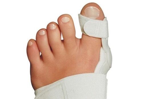 Valgus -Verformung