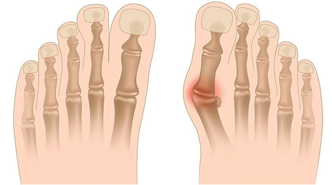 Behandlung der Valgus -Deformation